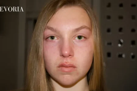 Pilaris on Face