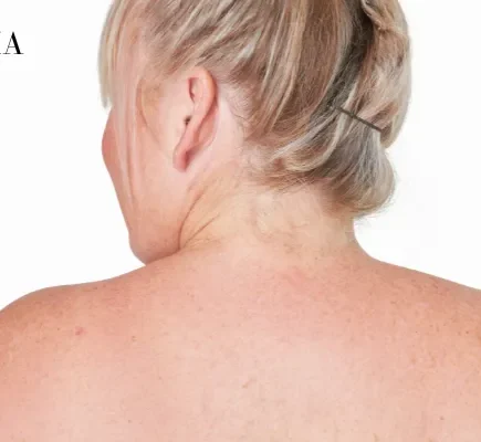 Raised Bumps on Skin