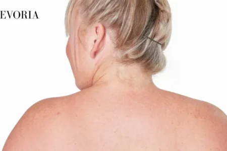 Raised Bumps on Skin
