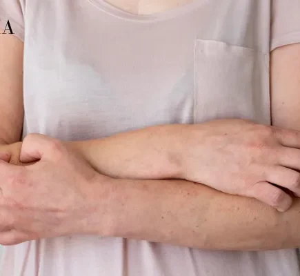 Pilaris Bumps