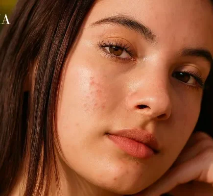 How to Get Rid of Black Spots on Face