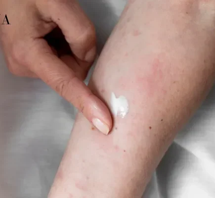 Xerosis (Dry Skin)