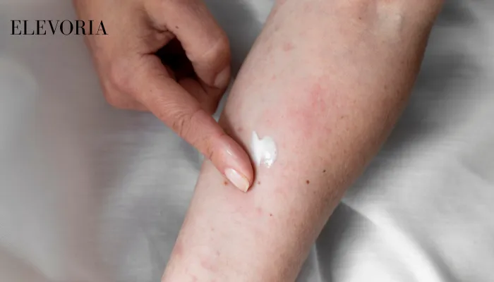 Xerosis (Dry Skin)
