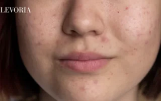 Pores
