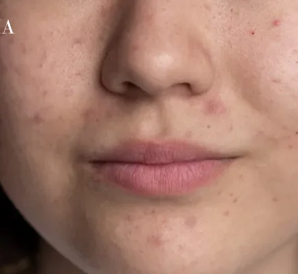 Pores