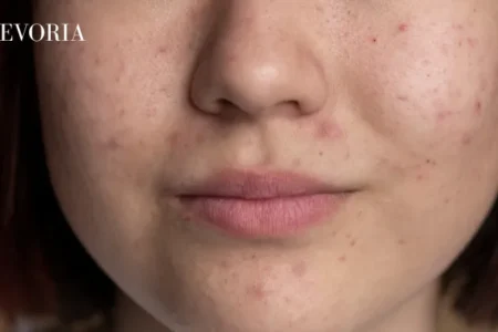 Pores