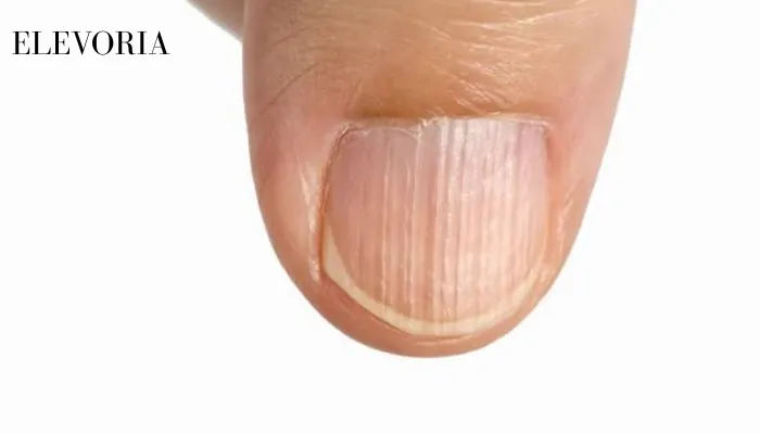 Ridges on Fingernails